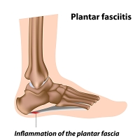 Treatments Options for Plantar Fasciitis