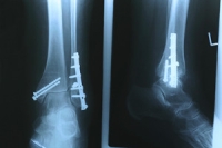 Fractured Ankle Pain