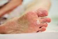 Can Sever’s Disease Affect Both Feet?