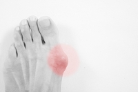 What You Need to Know About Your Bunion