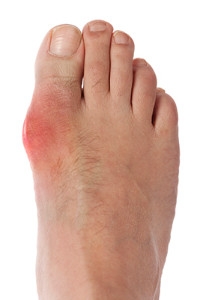 Possible Causes of Gout