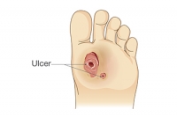 Understanding Slow Wound Healing in Diabetic Patients