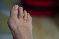 What Are Causes of Hammertoe?