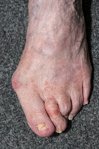 How Do I Treat My Bunion?