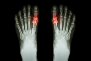 Painful Gout Attacks at Night