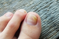 Common Symptoms of Toenail Fungus