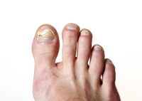 Toenail Problems and Treatments