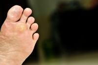 What is a Plantar Wart?