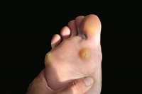 How to Treat Plantar Warts