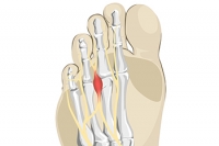 Foods to Eat and Morton’s Neuroma