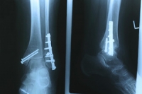Is Ankle Surgery Right for Me?