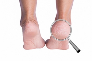 When Cracked Heels Become Painful