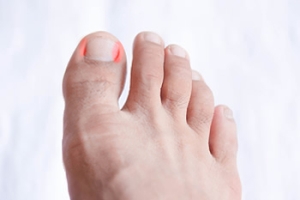 Are Ingrown Toenails Painful?