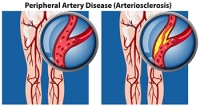 Peripheral Arterial Disease and Its Impact on the Feet