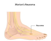 Causes of Morton’s Neuroma