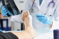 Types of Bunion Surgery