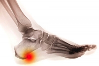 Causes and Symptoms of Heel Spurs