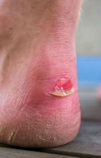 Managing Blisters