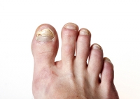 Where Did I Get Toenail Fungus From?