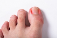Relief Solutions for an Ingrown Toenail