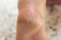 Causes of Cracked Heels Include Vitamin Deficiency