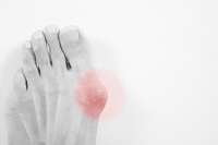 Various Reasons Why Bunions May Develop
